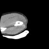 SPORK, NICO - 22.03.1976 - 02.08.2022 - CT obere Extremität - 17:56:57